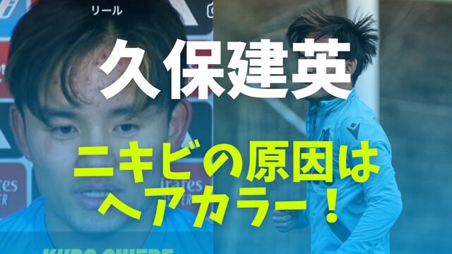 久保建英のニキビの原因はヘアカラー